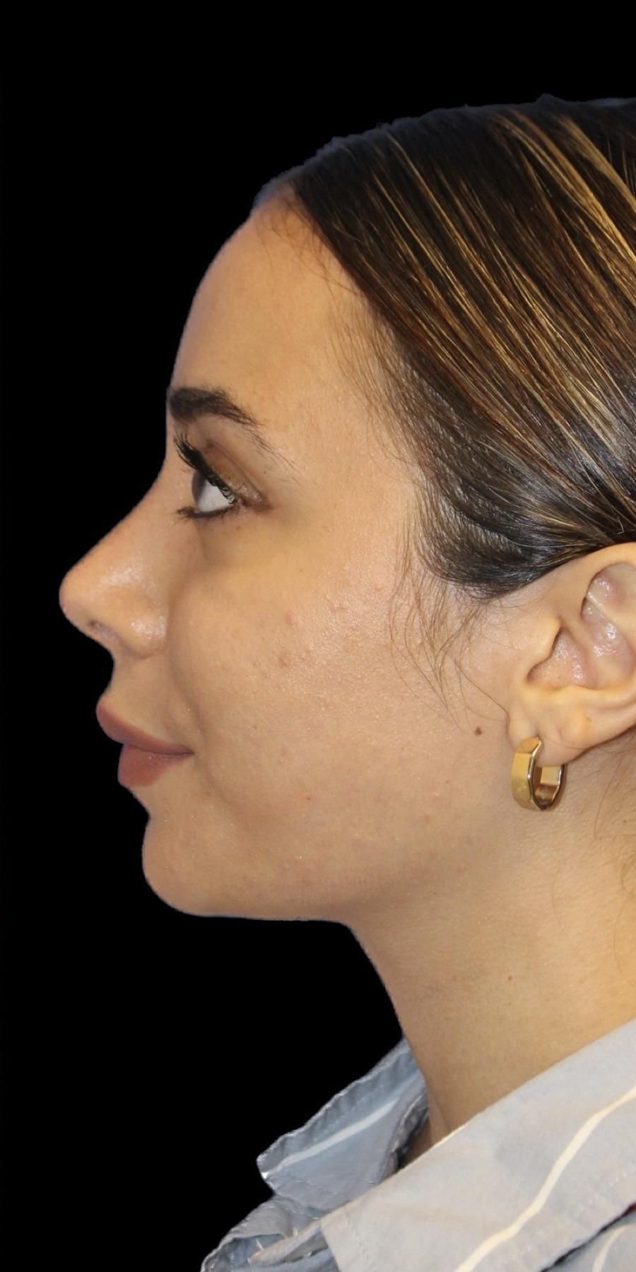 Aeris Plastic Surgery rhinoplasty after — Miami, FL