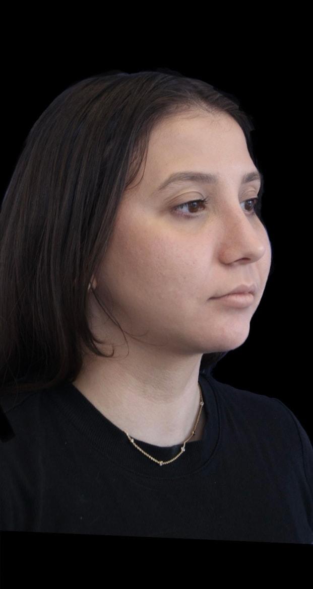 Rhinoplasty after at Aeris Plastic Surgery in Coral Gables, FL