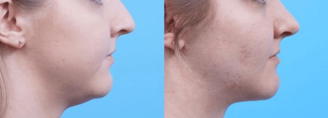 Neck Liposuction result at FORM DERM SPA in Cottonwood Heights, UT