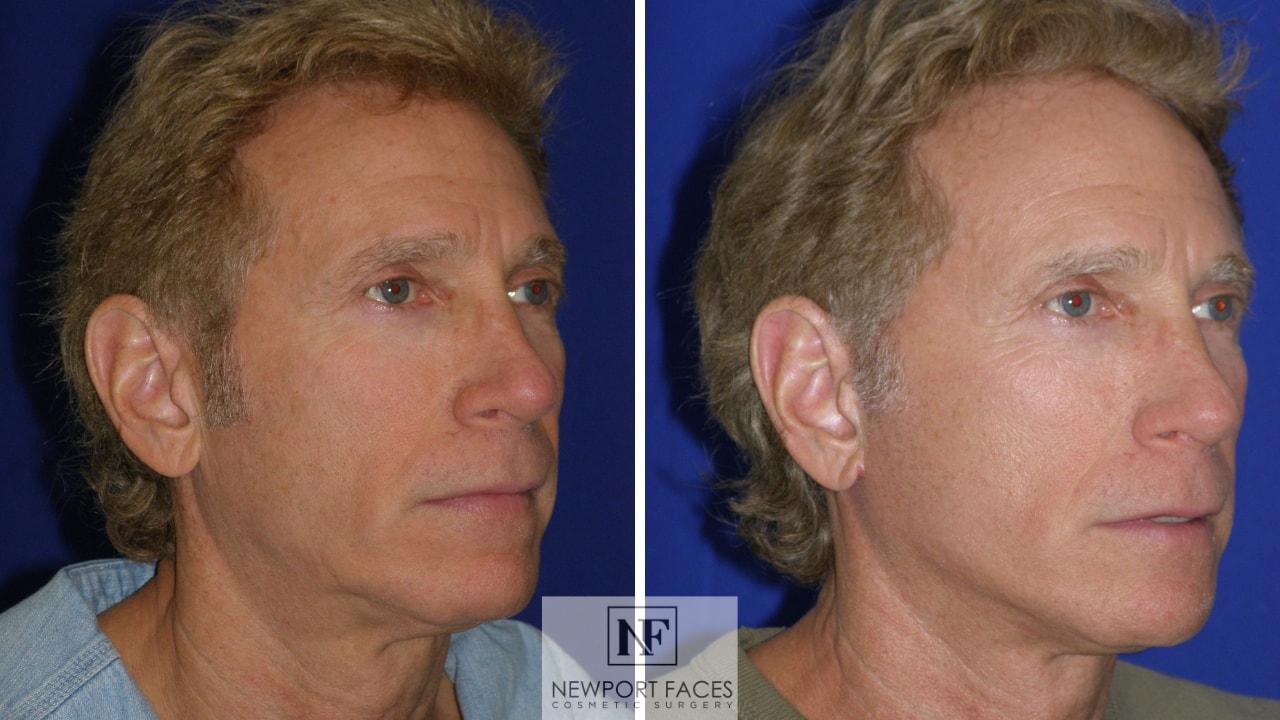 Newport Faces Cosmetic Surgery facelift result — Newport Beach, CA