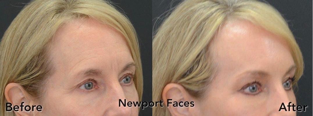 Newport Faces Cosmetic Surgery brow lift result — Newport Beach, CA