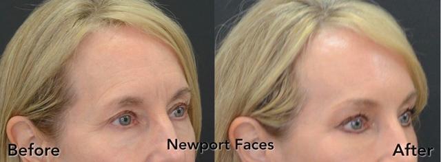 Brow Lift result at Newport Faces Cosmetic Surgery in Newport Beach, CA