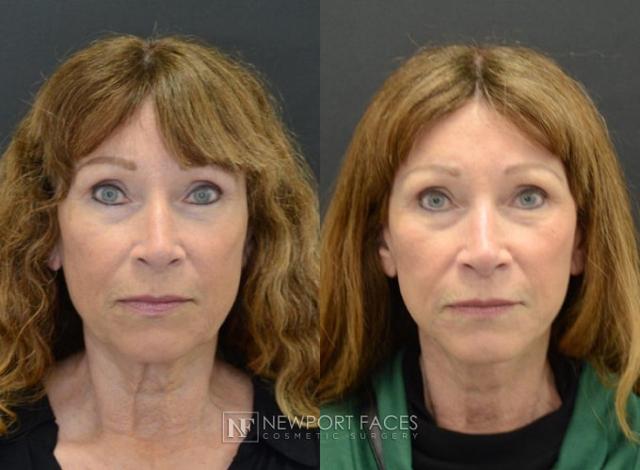 Laser Skin Resurfacing result at Newport Faces Cosmetic Surgery in Newport Beach, CA