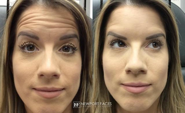 Botox result at Newport Faces Cosmetic Surgery in Newport Beach, CA