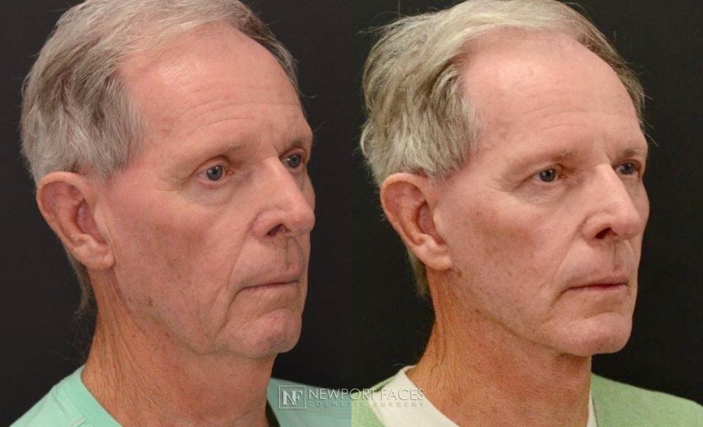 Newport Faces Cosmetic Surgery facelift result — Newport Beach, CA
