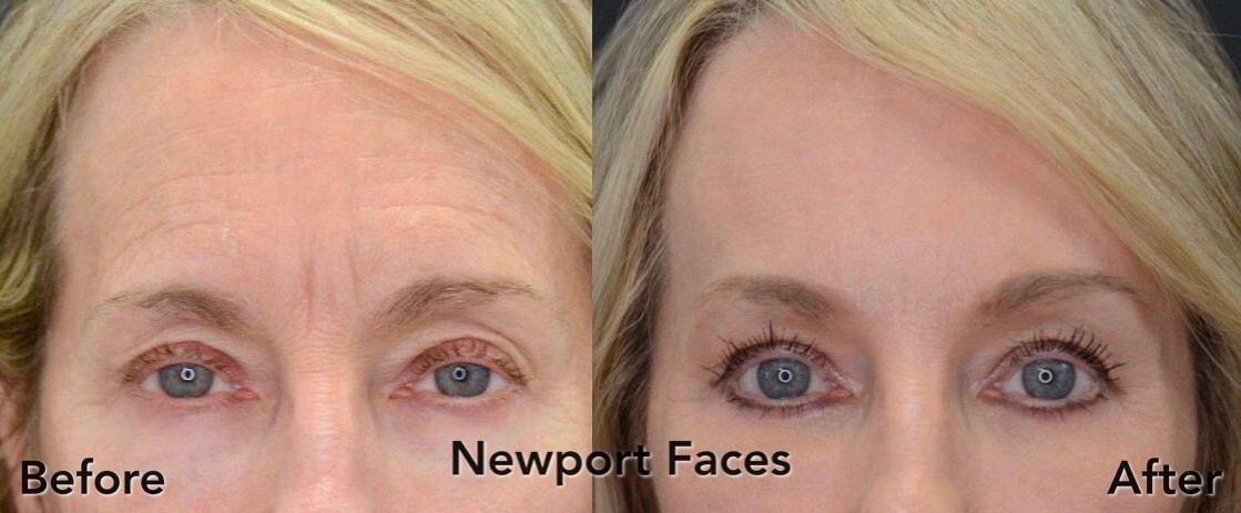 Newport Faces Cosmetic Surgery brow lift result — Newport Beach, CA