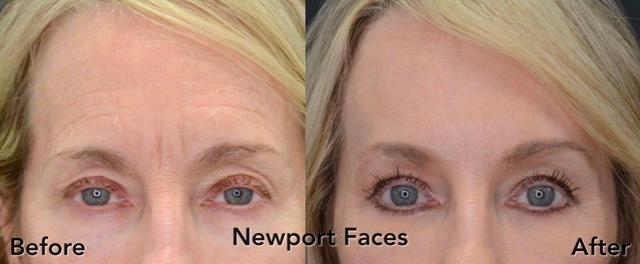 Brow Lift result at Newport Faces Cosmetic Surgery in Newport Beach, CA