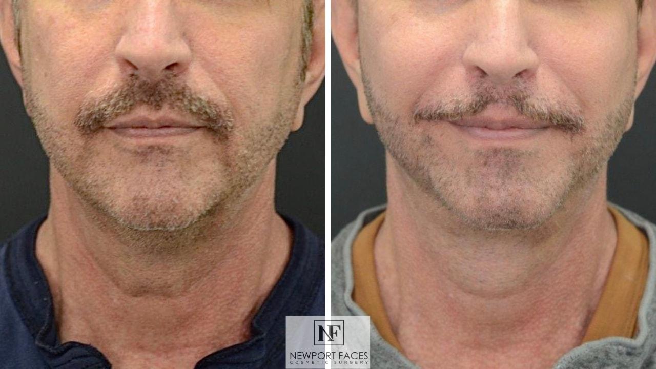 Newport Faces Cosmetic Surgery facelift result — Newport Beach, CA