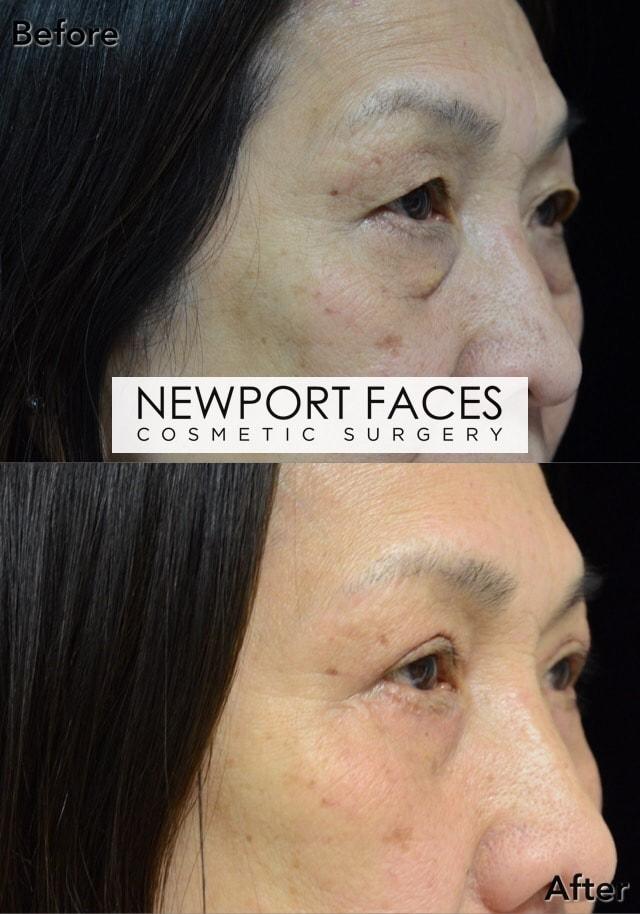 Blepharoplasty result at Newport Faces Cosmetic Surgery in Newport Beach, CA