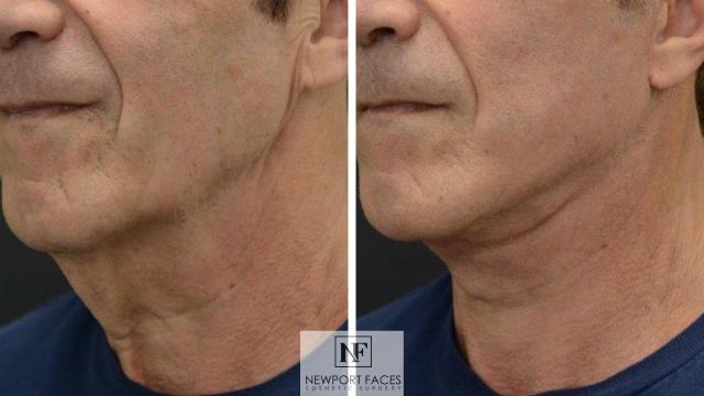 Mini Facelift result at Newport Faces Cosmetic Surgery in Newport Beach, CA