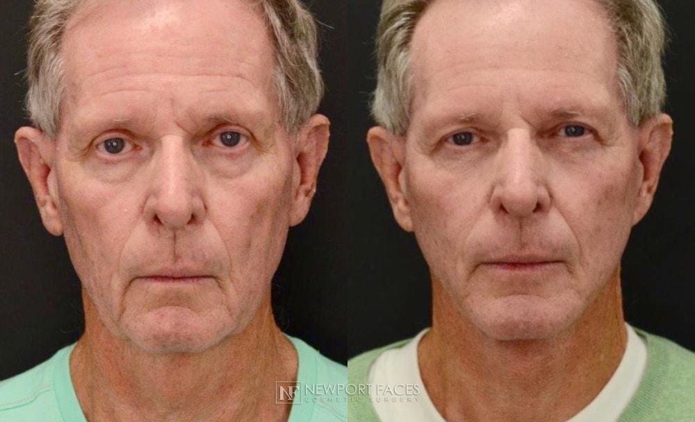 Newport Faces Cosmetic Surgery facelift result — Newport Beach, CA