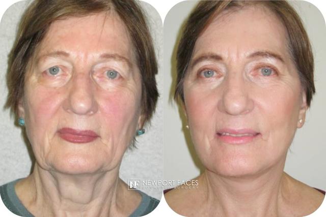 Laser Skin Resurfacing result at Newport Faces Cosmetic Surgery in Newport Beach, CA