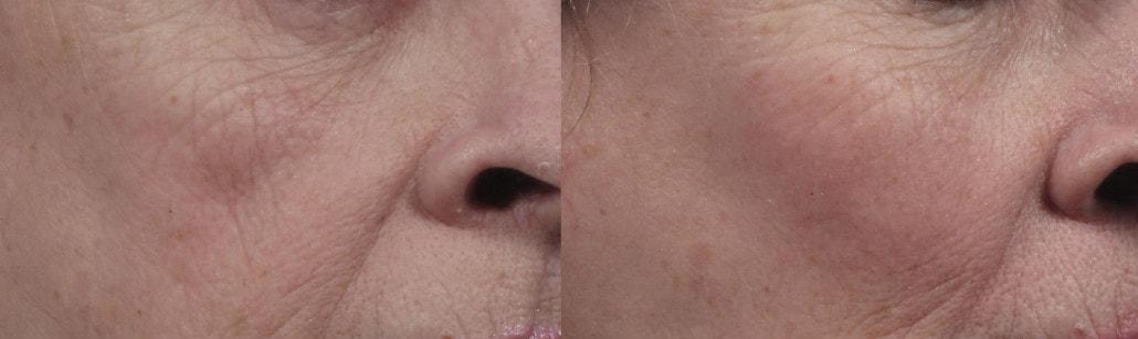 Brett Kotlus, MD fat transfer result — New York, NY