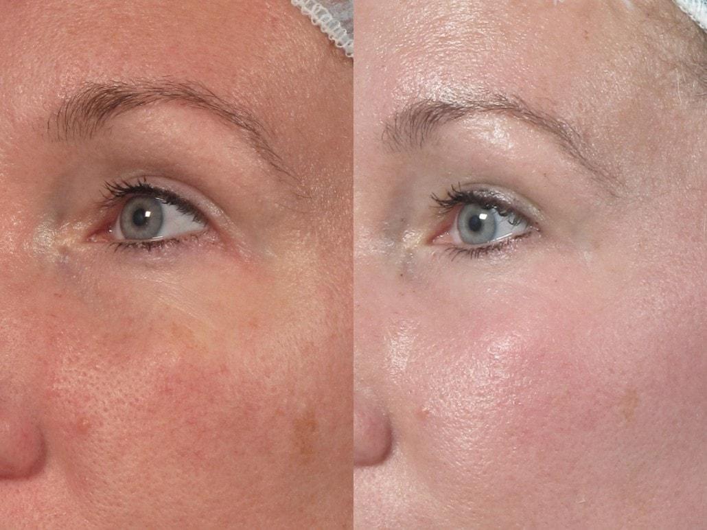 Brett Kotlus, MD laser treatment result — New York, NY