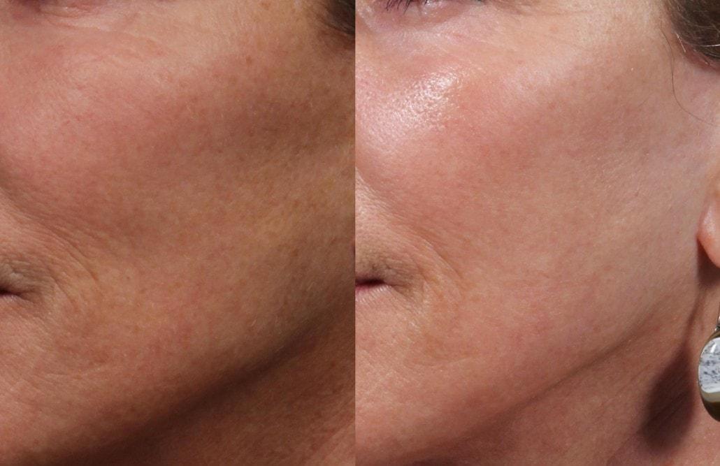 Brett Kotlus, MD laser treatment result — New York, NY
