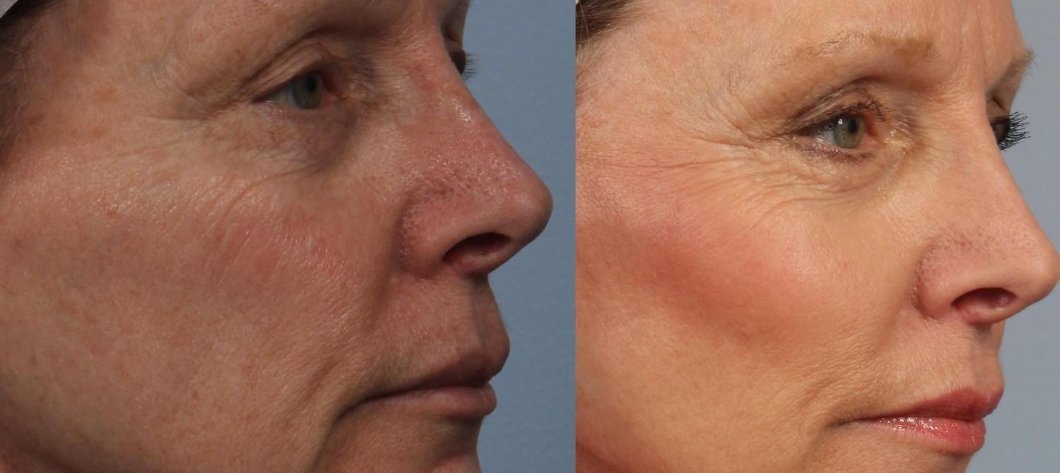 Brett Kotlus, MD fat transfer result — New York, NY