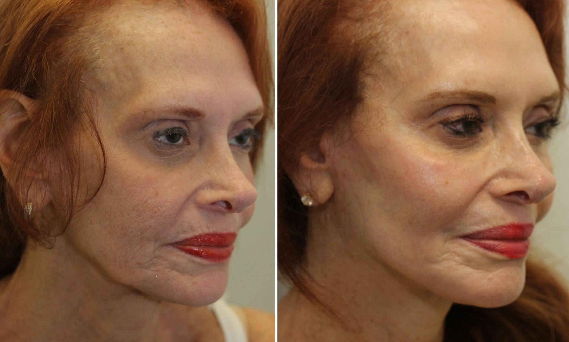 Brett Kotlus, MD facelift result — New York, NY