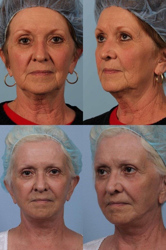 Brett Kotlus, MD facelift result — New York, NY