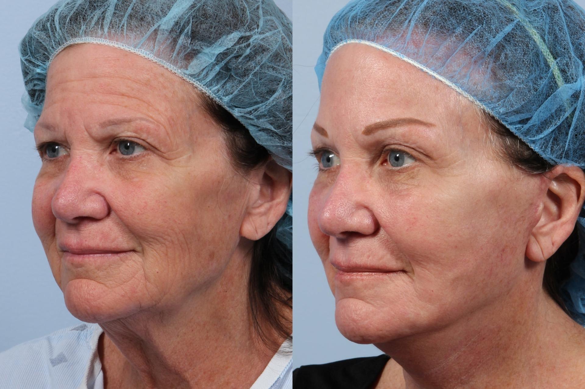 Brett Kotlus, MD facelift result — New York, NY