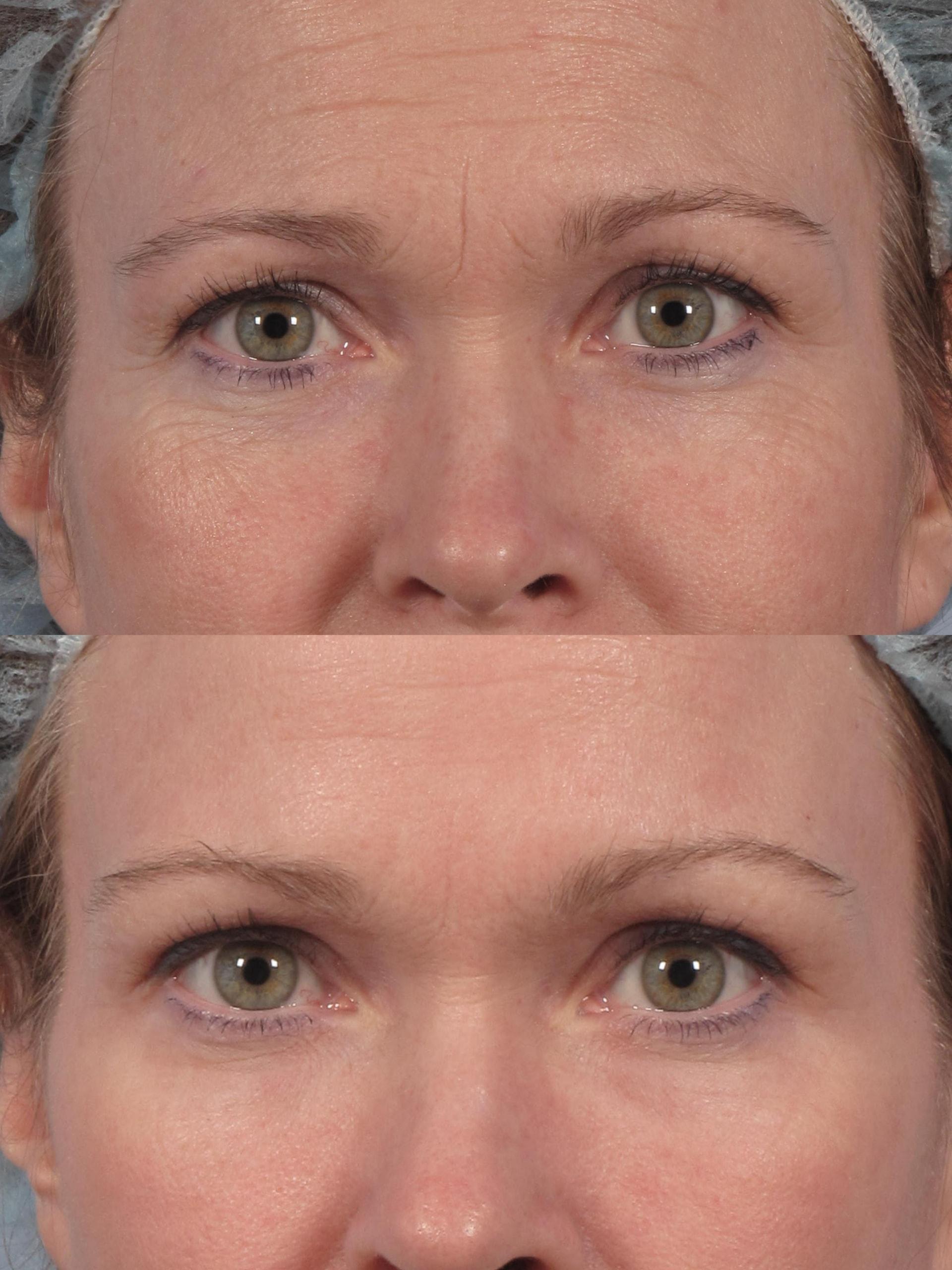 Brett Kotlus, MD laser treatment result — New York, NY