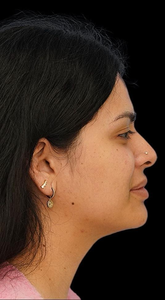 Lahar Plastic Surgery neck liposuction after — Beverly Hills, CA