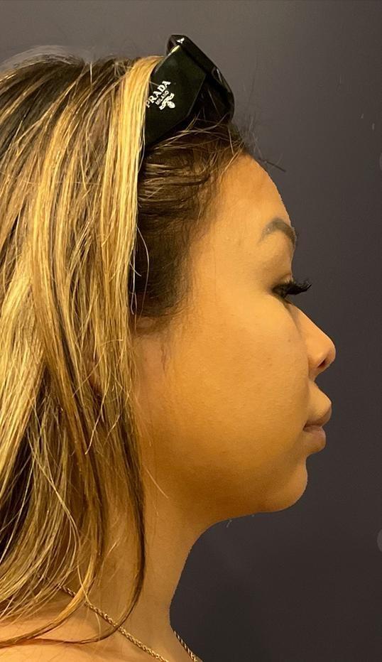 Lahar Plastic Surgery neck liposuction after — Beverly Hills, CA