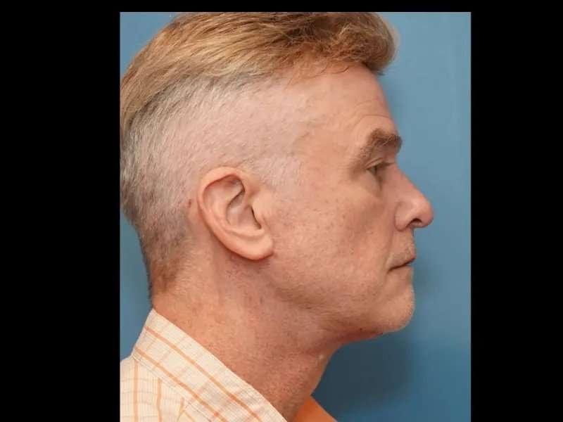 Lahar Plastic Surgery neck lift after — Beverly Hills, CA