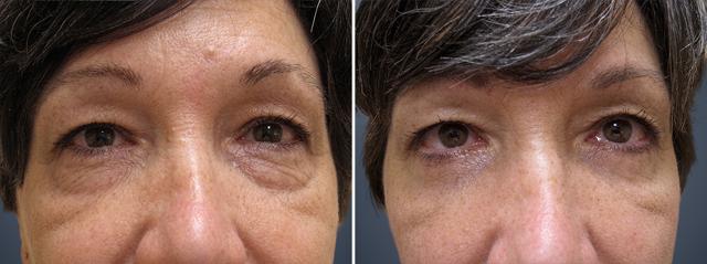 Blepharoplasty result at David W. Allison, MD in Philadelphia, PA