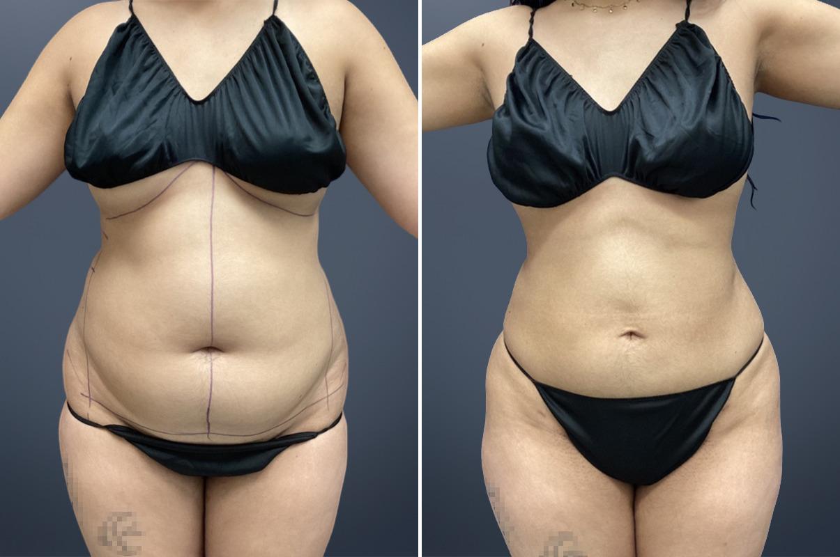 David W. Allison, MD tummy tuck result — Philadelphia, PA