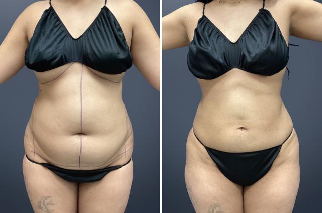Tummy Tuck result at David W. Allison, MD in Philadelphia, PA