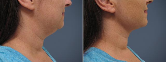 Neck Lift result at David W. Allison, MD in Philadelphia, PA