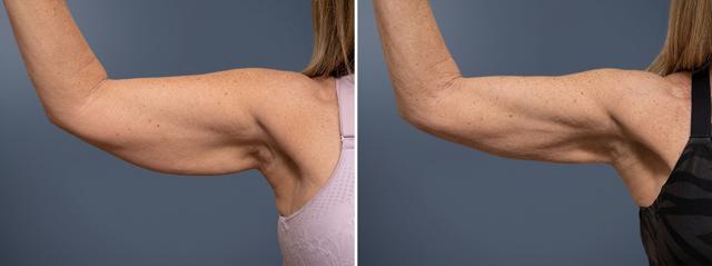 Liposuction result at David W. Allison, MD in Philadelphia, PA