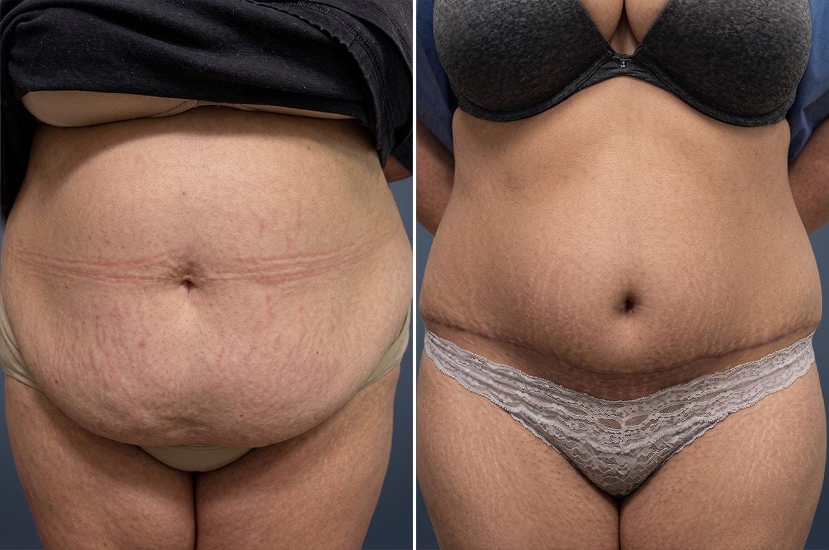 David W. Allison, MD tummy tuck result — Philadelphia, PA