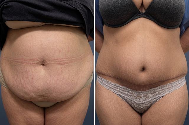 Mini Tummy Tuck result at David W. Allison, MD in Philadelphia, PA