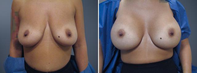 Breast Augmentation result at David W. Allison, MD in Philadelphia, PA