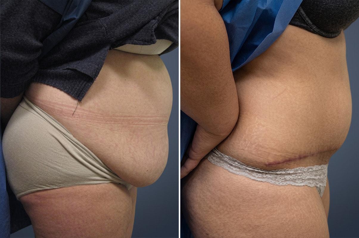 David W. Allison, MD tummy tuck result — Philadelphia, PA