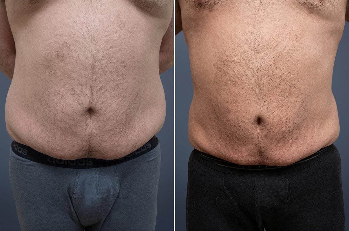 David W. Allison, MD liposuction result — Philadelphia, PA