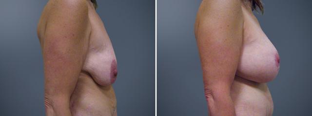 Breast Augmentation result at David W. Allison, MD in Philadelphia, PA
