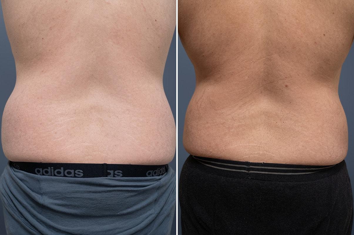 David W. Allison, MD liposuction result — Philadelphia, PA