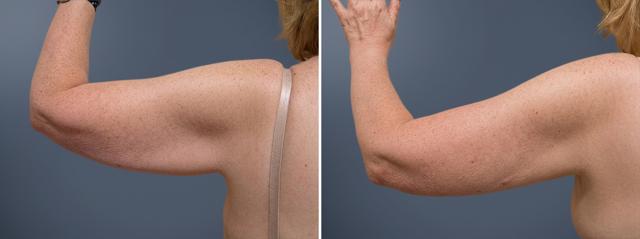 Brazilian Butt Lift result at David W. Allison, MD in Philadelphia, PA