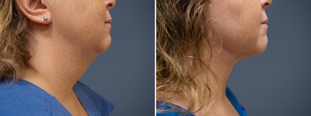 Neck Lift result at David W. Allison, MD in Philadelphia, PA