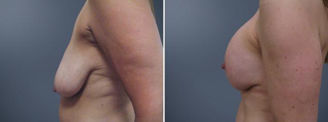 Breast Augmentation result at David W. Allison, MD in Philadelphia, PA
