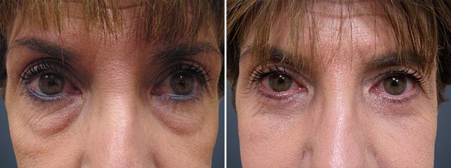 Blepharoplasty result at David W. Allison, MD in Philadelphia, PA