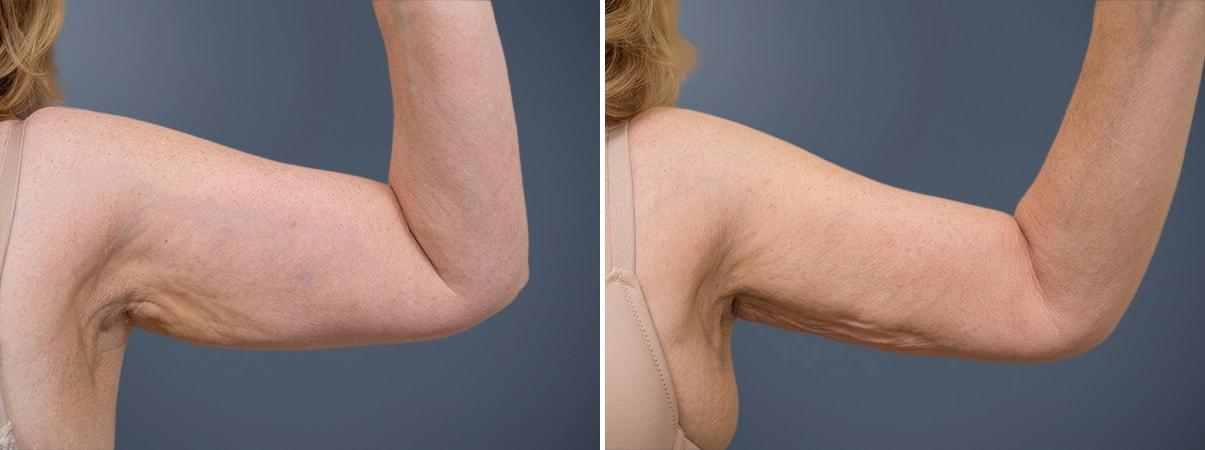 David W. Allison, MD liposuction result — Philadelphia, PA