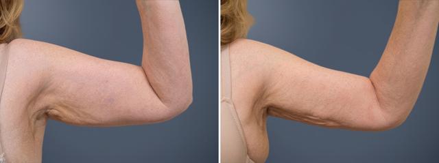 Liposuction result at David W. Allison, MD in Philadelphia, PA
