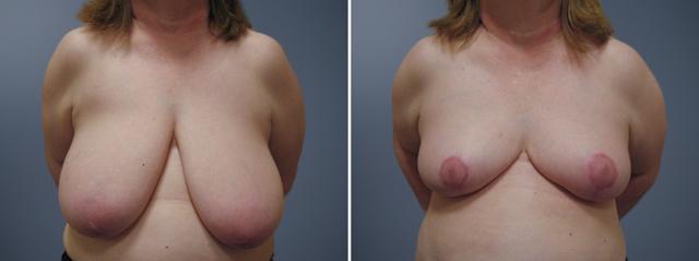 Breast Augmentation result at David W. Allison, MD in Philadelphia, PA