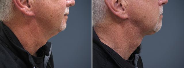 Neck Lift result at David W. Allison, MD in Philadelphia, PA