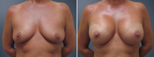 Breast Augmentation result at David W. Allison, MD in Philadelphia, PA