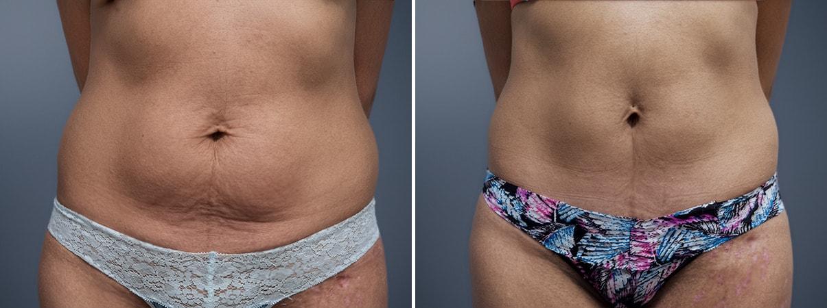 David W. Allison, MD tummy tuck result — Philadelphia, PA