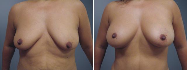 Breast Augmentation result at David W. Allison, MD in Philadelphia, PA